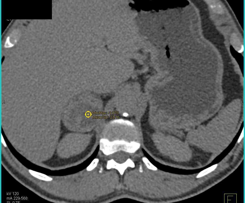 Cystic Pheochromocytoma - CTisus CT Scan