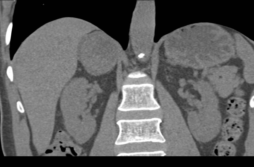 Adrenal Myelolipoma - CTisus CT Scan