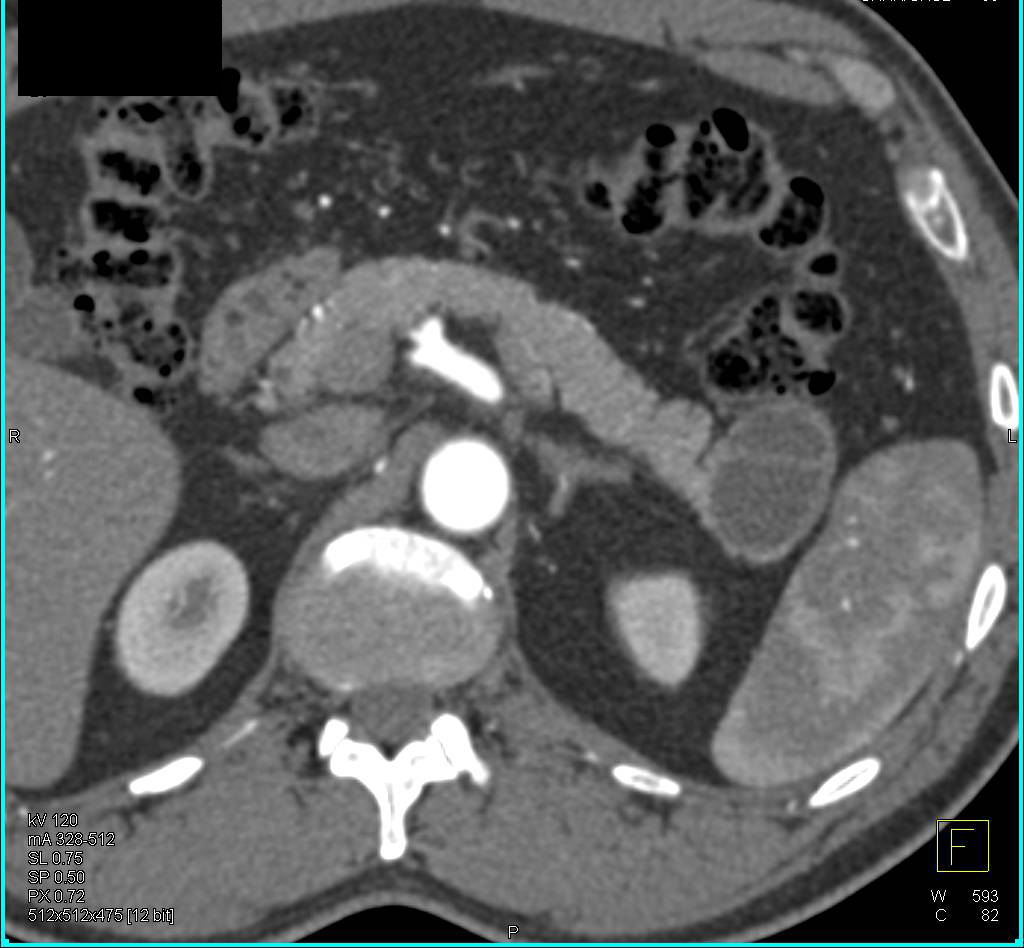 Cystic Neuroendocrine Tumor in Tail of the Pancreas - CTisus CT Scan