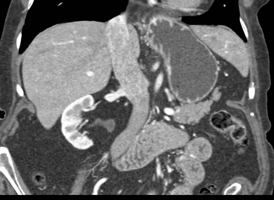 Normal Stomach and Small Bowel - CTisus CT Scan