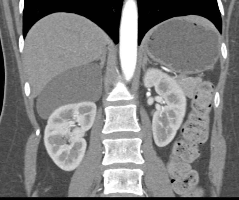 Adrenal Cyst - CTisus CT Scan