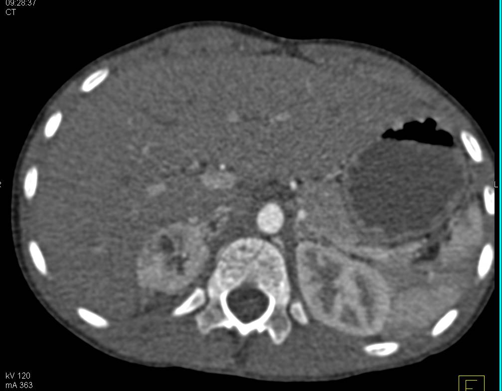 Pheochromocytoma of the Adrenal Gland - CTisus CT Scan