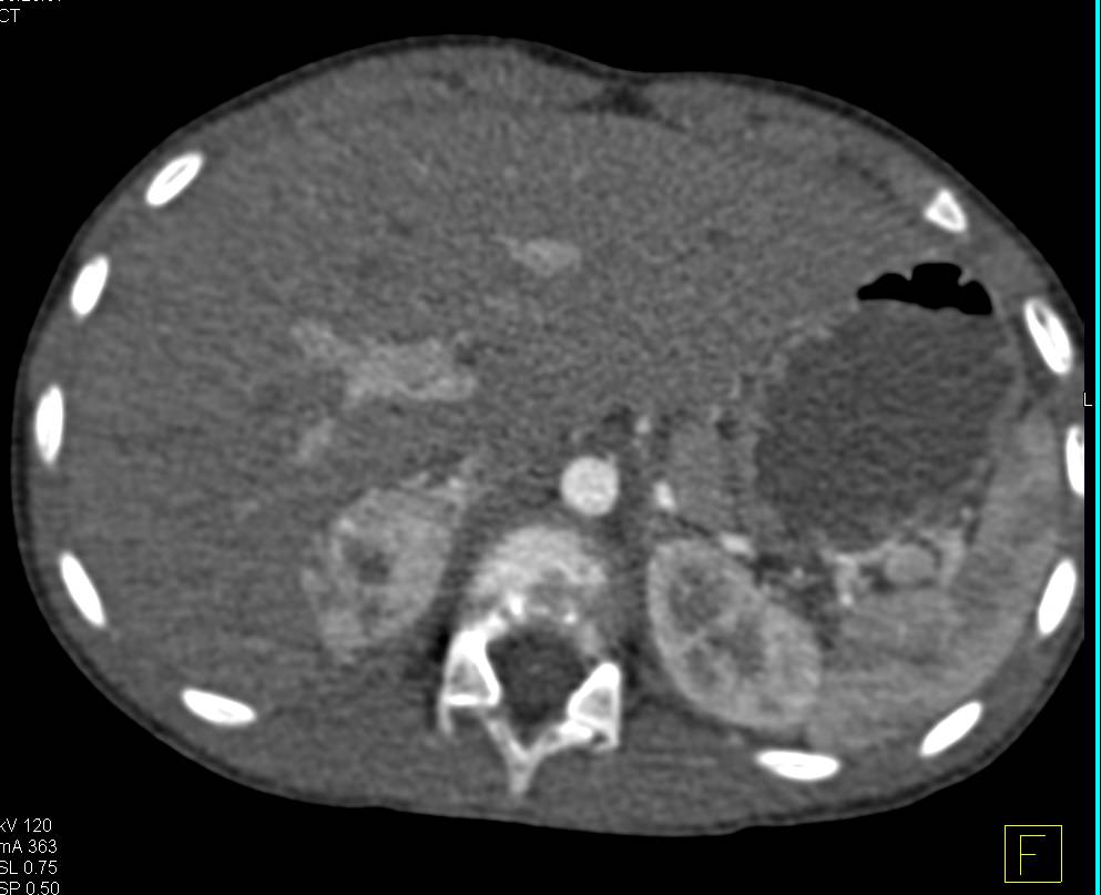 Pheochromocytoma - CTisus CT Scan