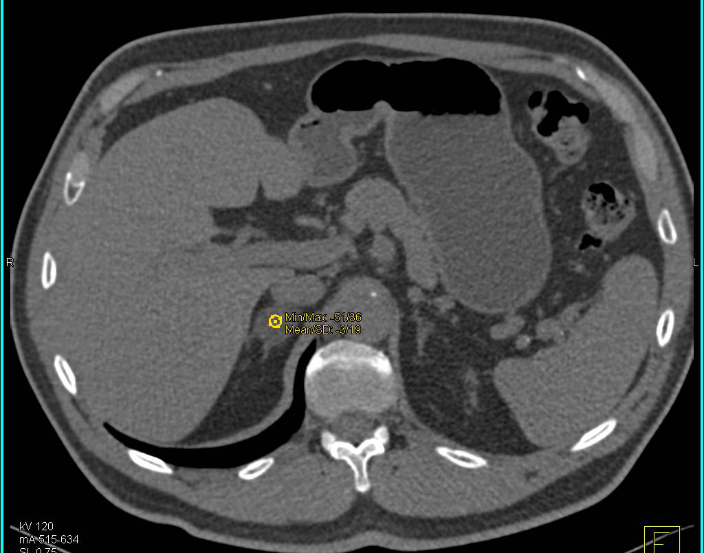 Right Adrenal Adenoma - CTisus CT Scan