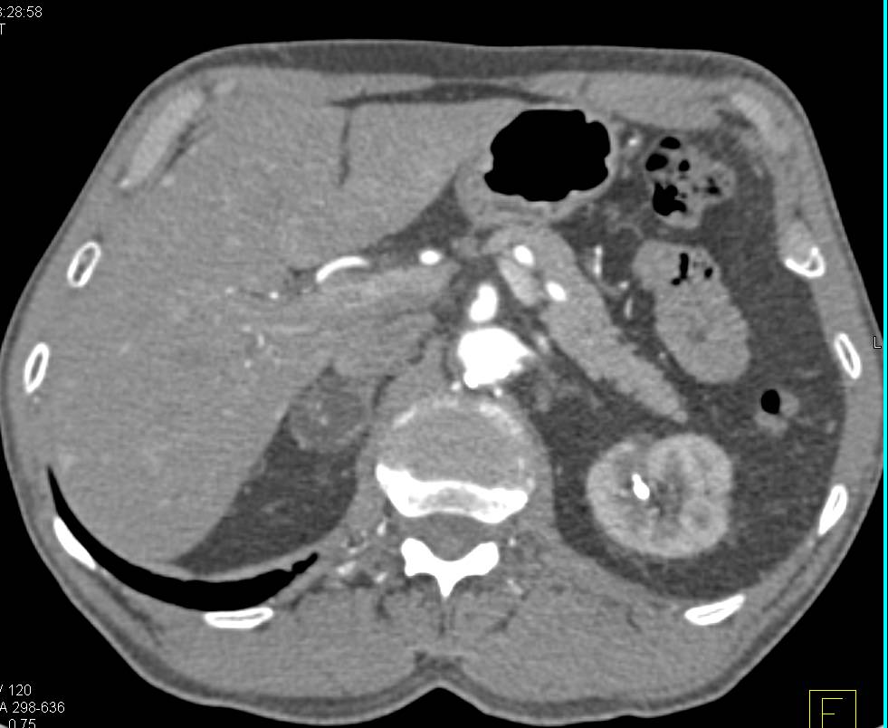 Adrenal Adenoma - CTisus CT Scan