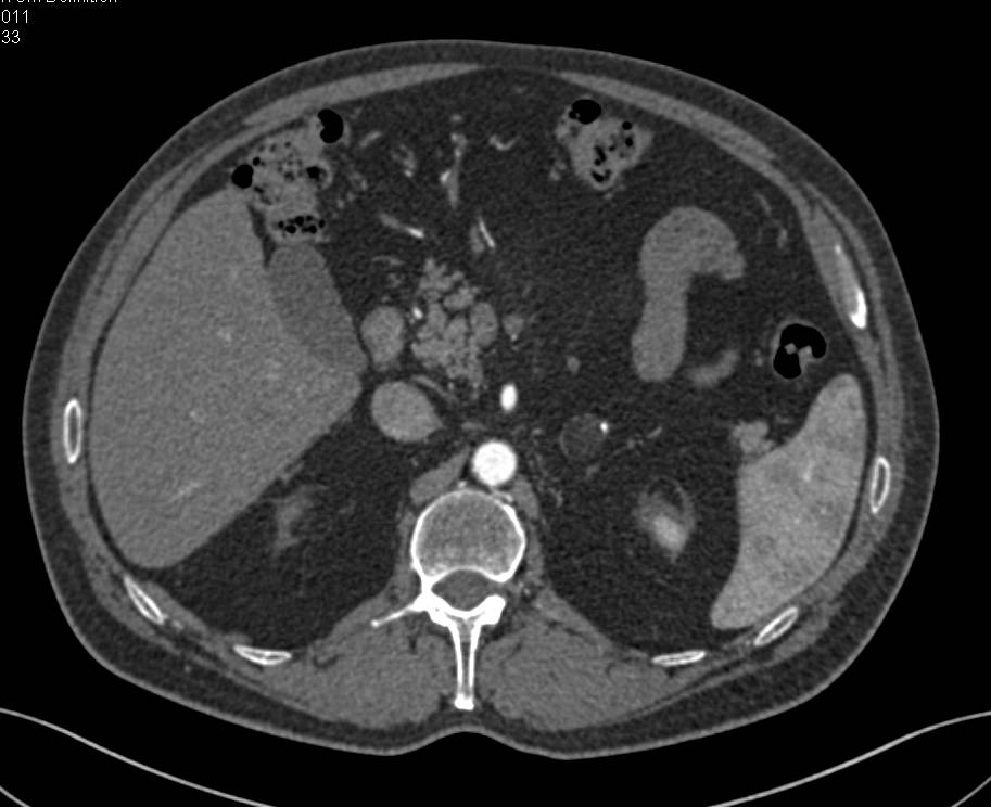 Left Adrenal Myelolipoma - CTisus CT Scan