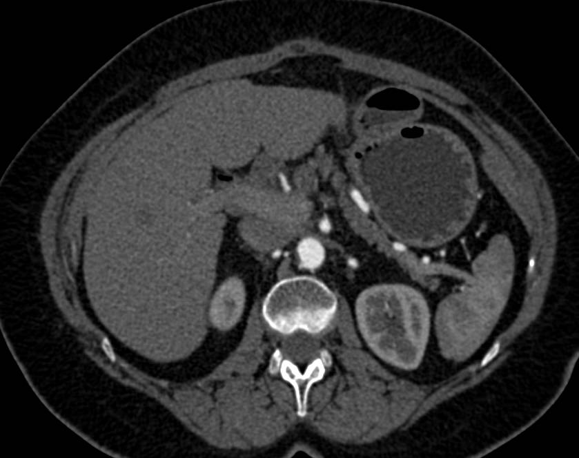 Pheochromocytoma Right Adrenal - CTisus CT Scan