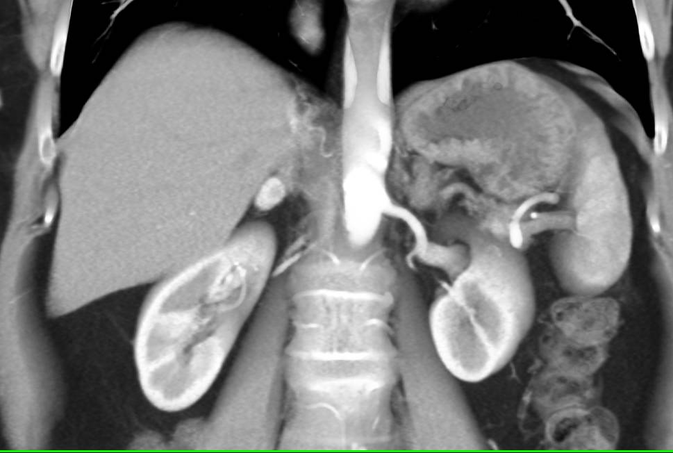 Pheochromocytoma Right Adrenal Gland - CTisus CT Scan