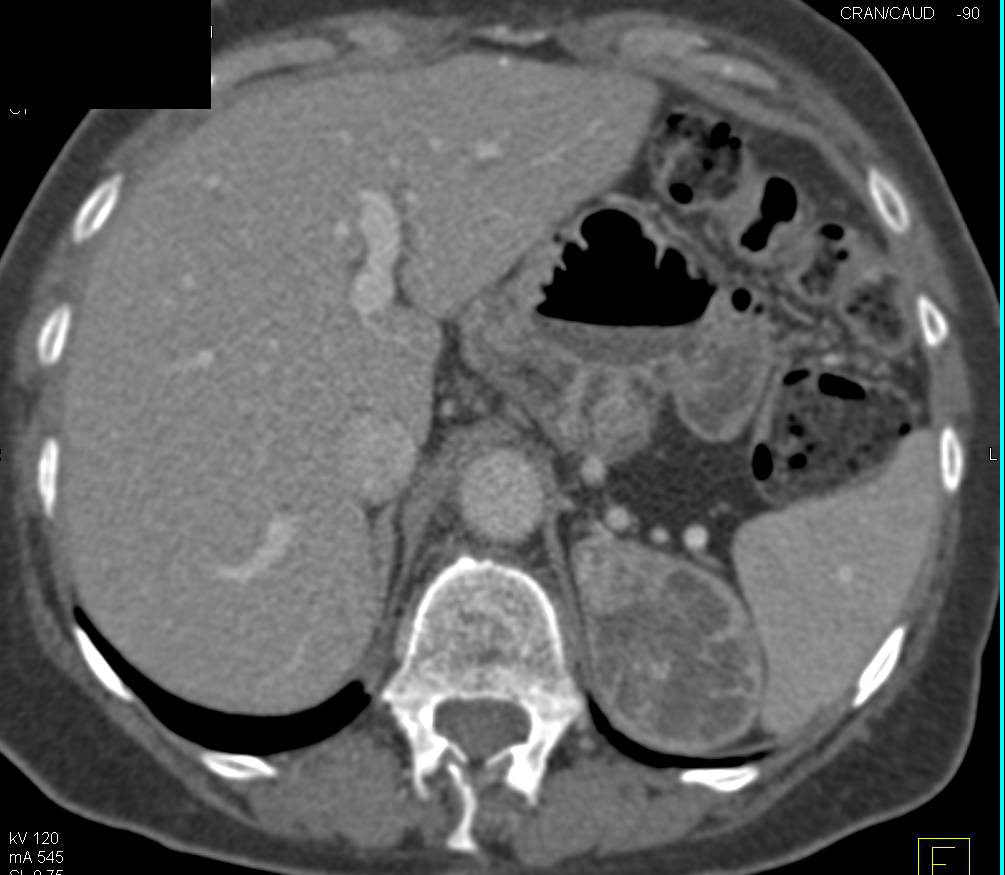 Left Adrenal Myelolipoma - CTisus CT Scan