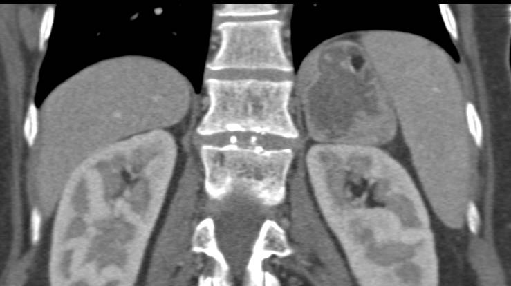 Adrenal Myelolipoma with Fat and Calcification - CTisus CT Scan