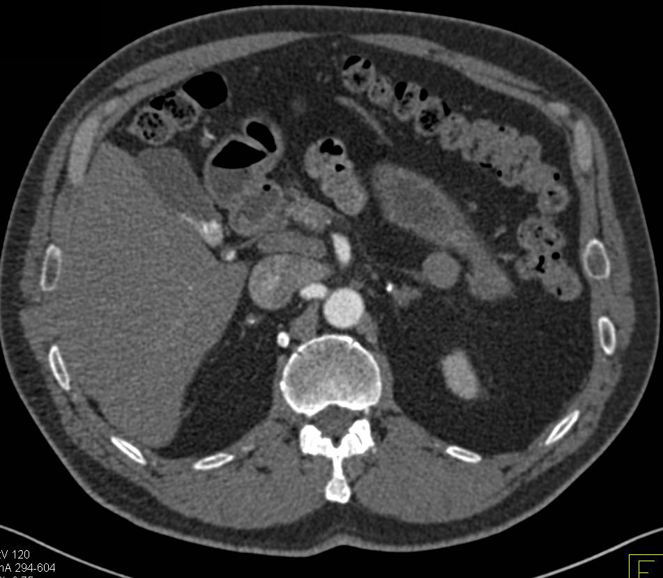 Calcified Atrophic Adrenal Glands due to Prior Hemorrhage - CTisus CT Scan