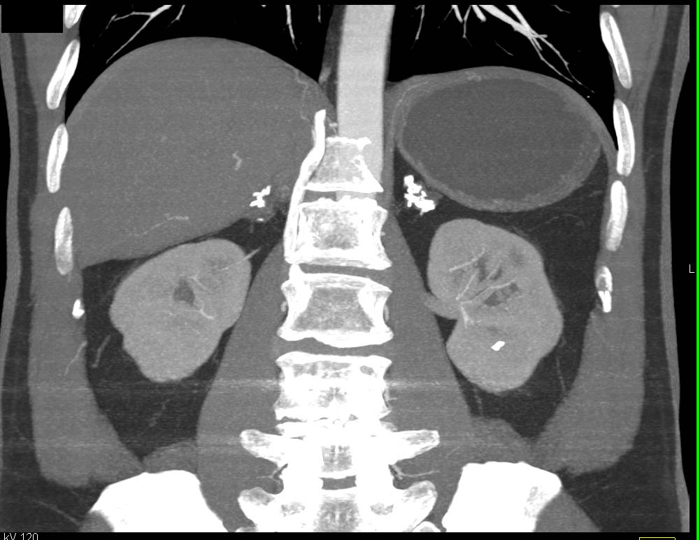 Calcified Adrenal Glands due to Prior Granulomatous Disease - CTisus CT Scan