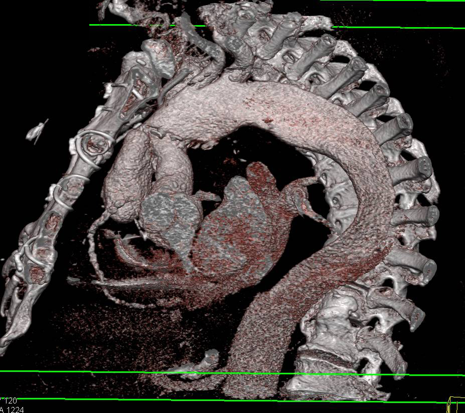 Dilated Ascending Aorta with Abnormal Arch - CTisus CT Scan