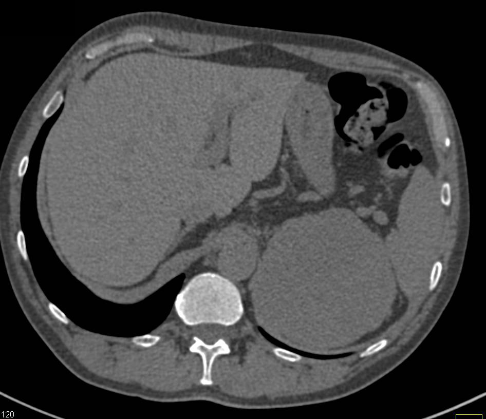 Adrenal Carcinoma - CTisus CT Scan