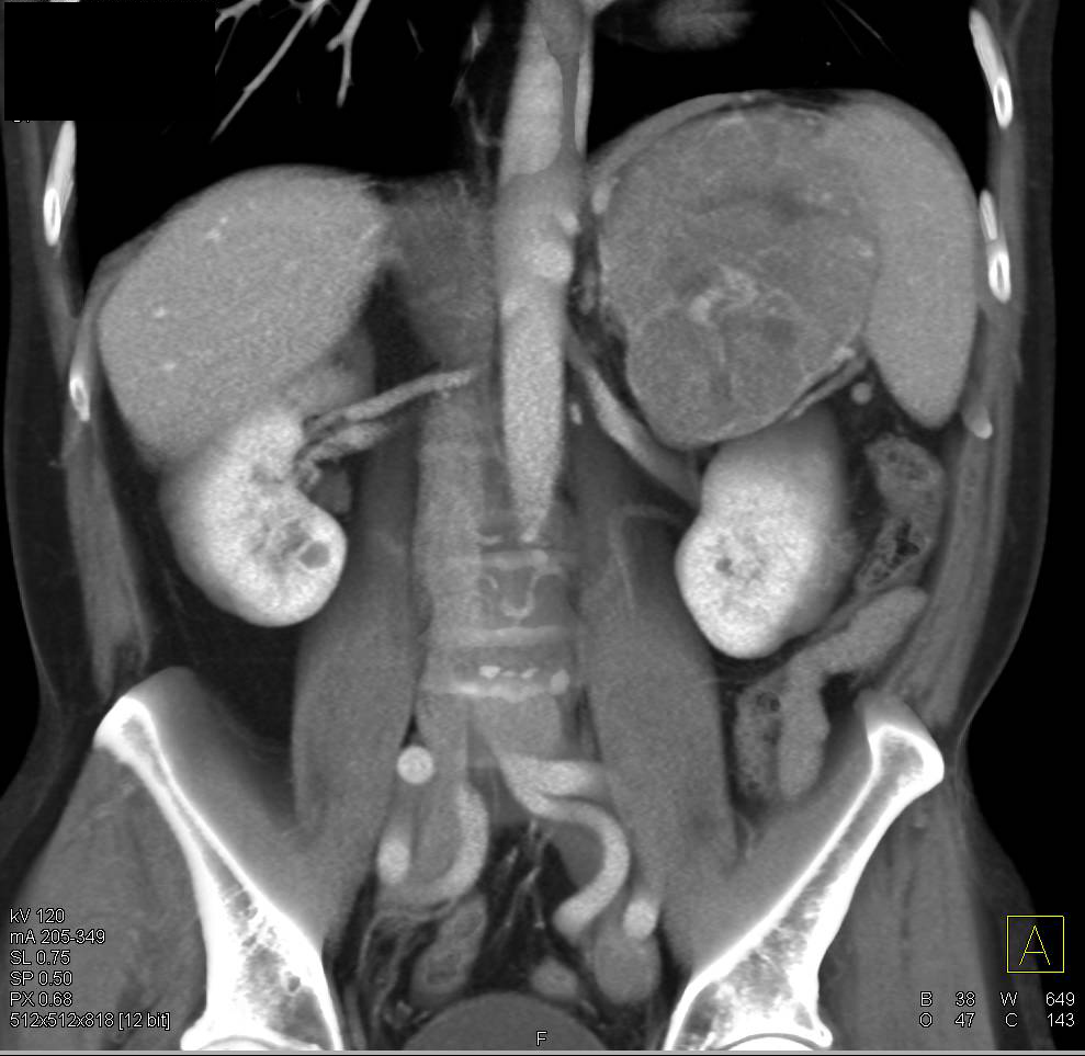 Primary Adrenal Carcinoma - CTisus CT Scan