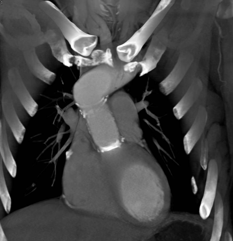 Aortic Root and Abdominal Aortic Aneurysms Post Repair - CTisus CT Scan