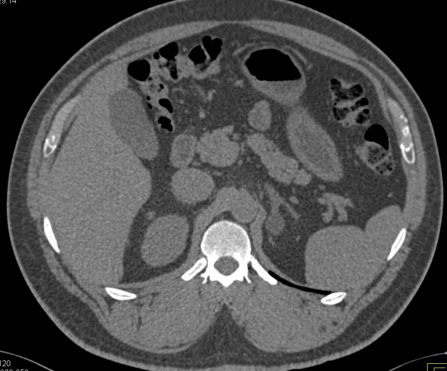 Left Adrenal Adenoma - CTisus CT Scan