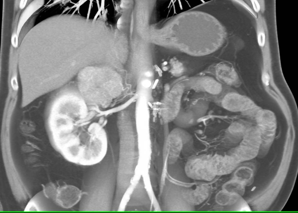 Metastatic Renal Cell Carcinoma to the Contralateral Adrenal - CTisus CT Scan