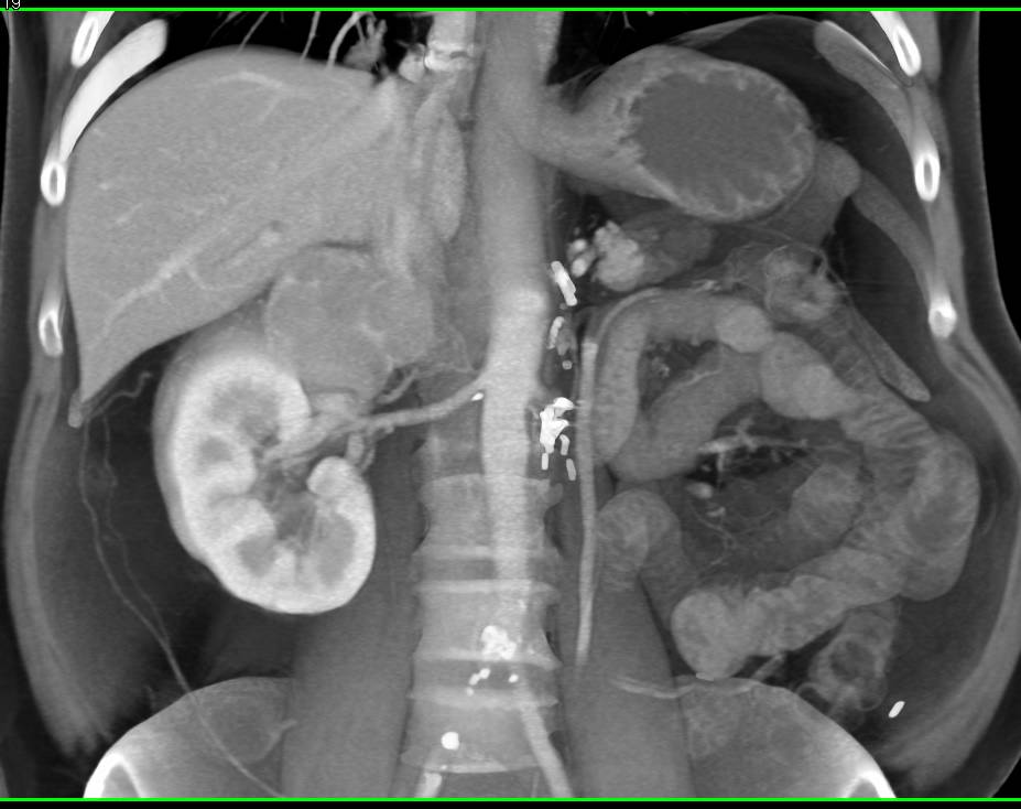 Renal Carcinoma Metastatic to Contralateral Adrenal Gland - CTisus CT Scan