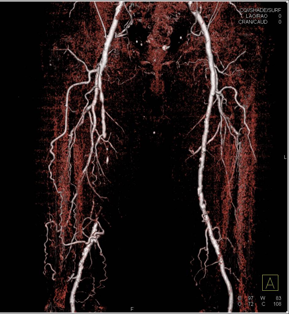 CTA Runoff with Right Superficial Femoral Artery (SFA) Occlusion and Collaterals - CTisus CT Scan