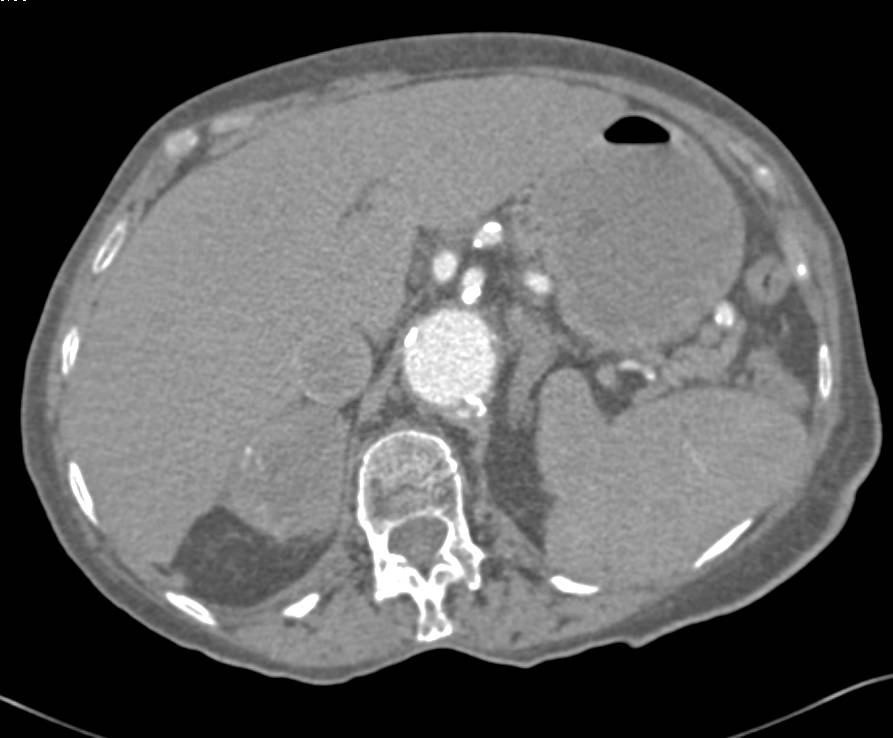 Myelolipoma Right Adrenal Gland - CTisus CT Scan