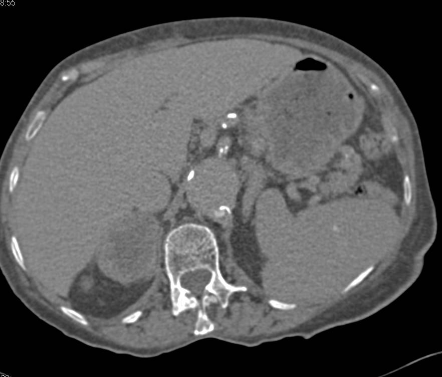 Metastases to the Right Adrenal Gland from Renal Cell Carcinoma - CTisus CT Scan