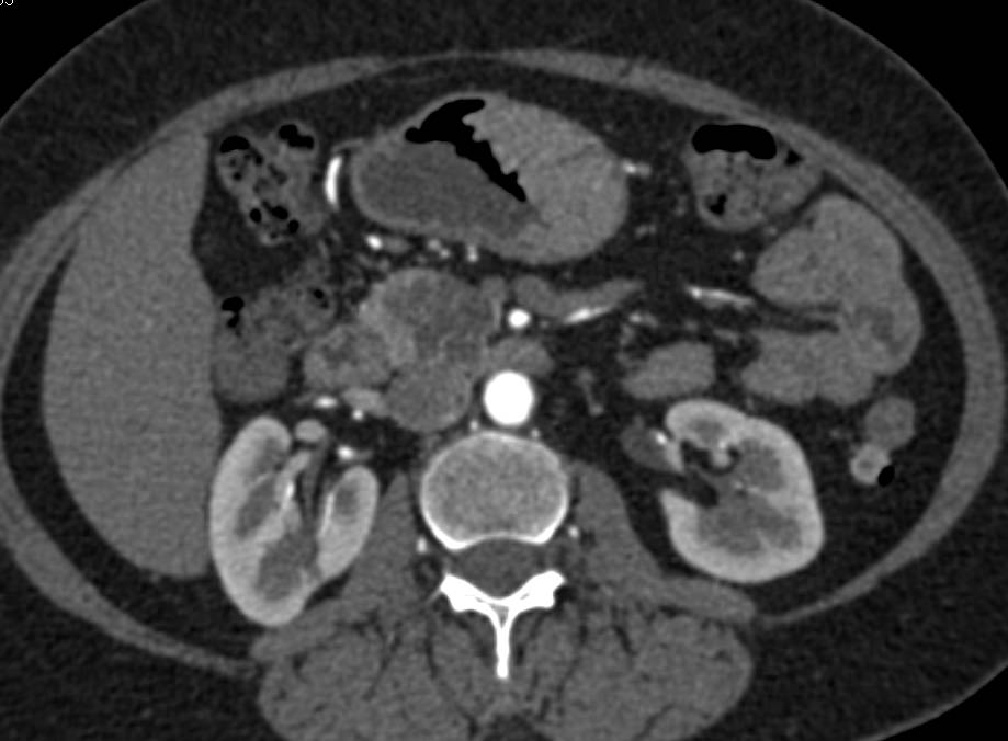 Serous Cystadenoma of the Pancreas with Vascular Map - CTisus CT Scan