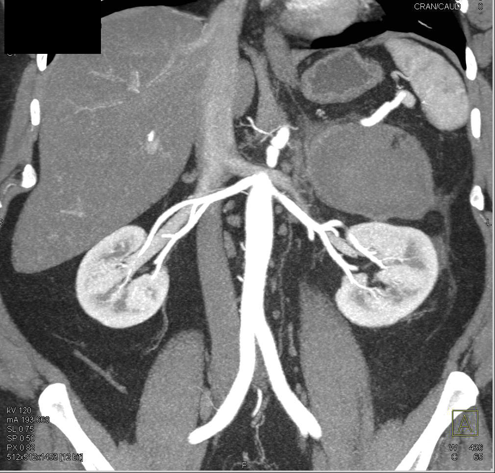 Bleed in Region of Left Adrenal Gland - CTisus CT Scan