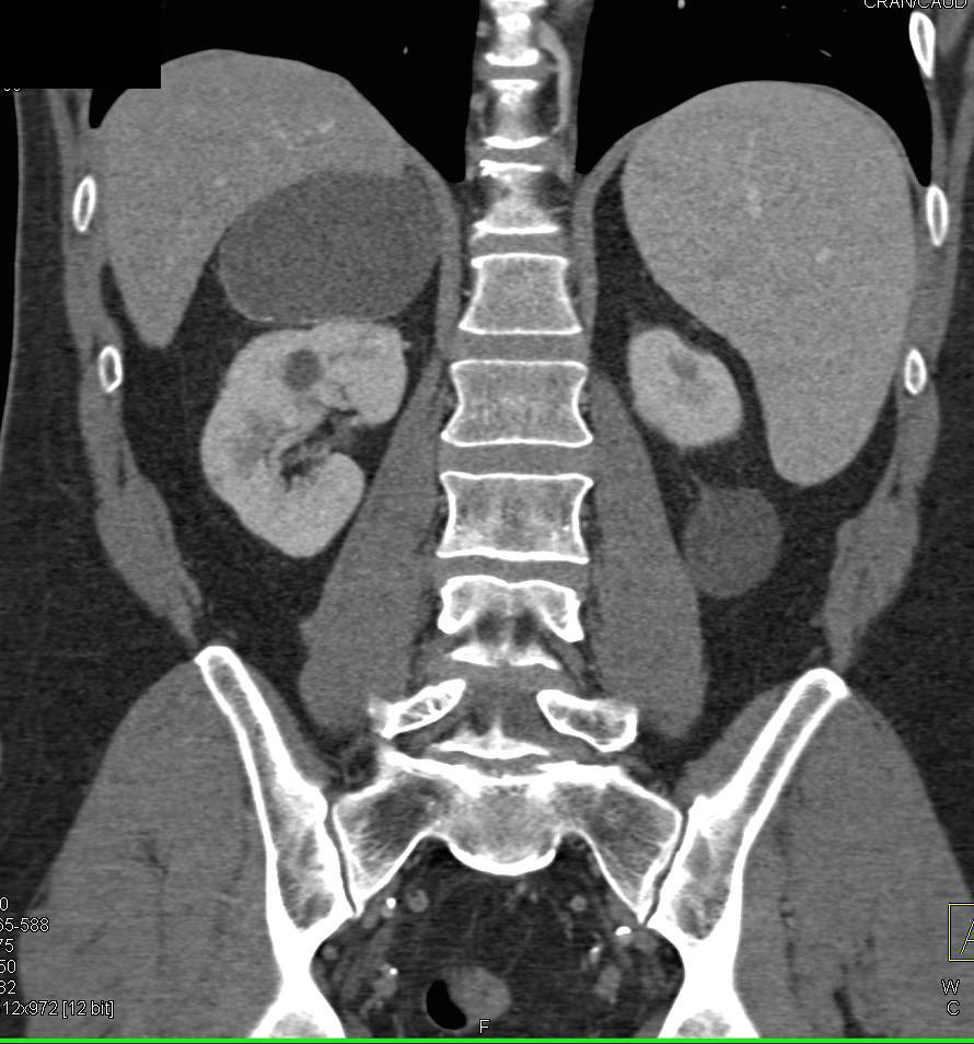 Adrenal Cyst - CTisus CT Scan