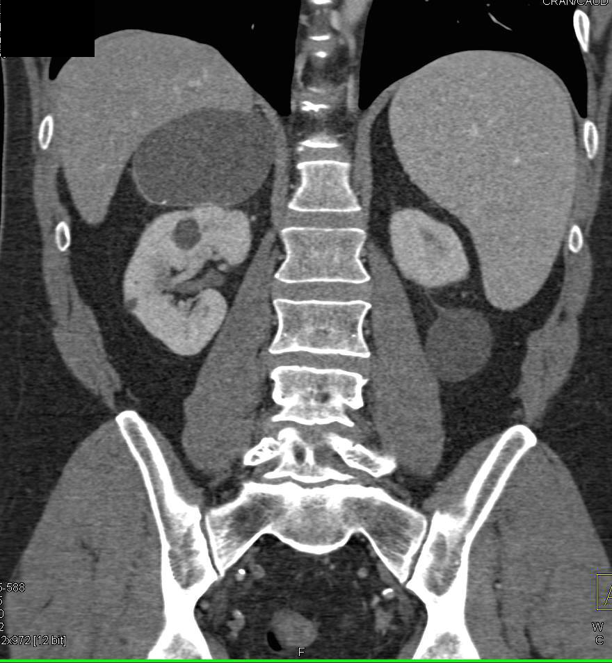 Adrenal Cyst - Adrenal Case Studies - CTisus CT Scanning