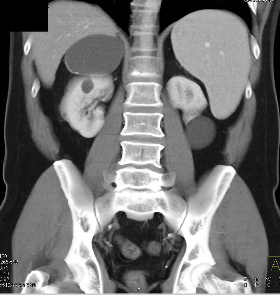 Simple Adrenal Cyst - CTisus CT Scan