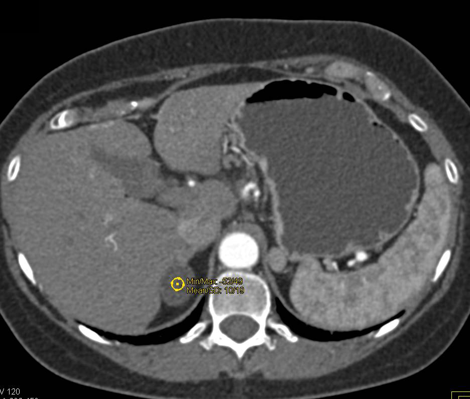 Adrenal Adenoma - CTisus CT Scan