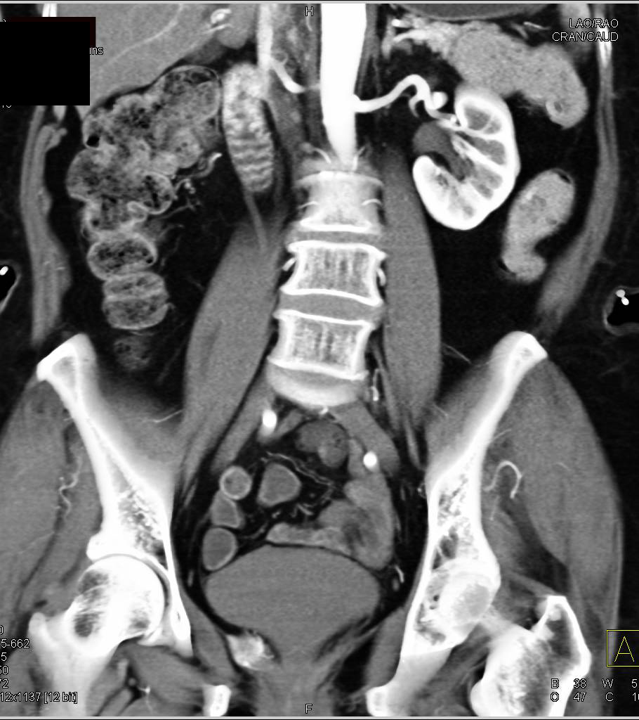 Liver and Pelvic Tumor in 3D Display - CTisus CT Scan