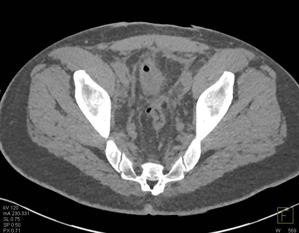 CT Cystogram with Extraperitoneal Leak of Contrast - CTisus CT Scan