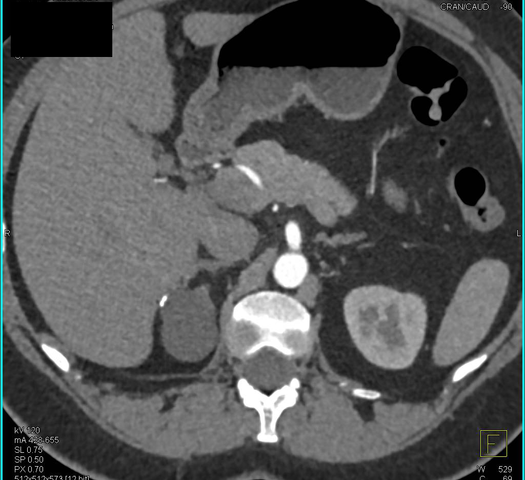 Right Adrenal Adenoma - CTisus CT Scan