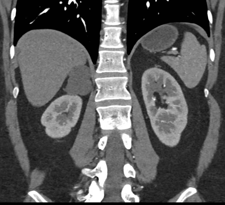 Right Adrenal Adenoma - CTisus CT Scan