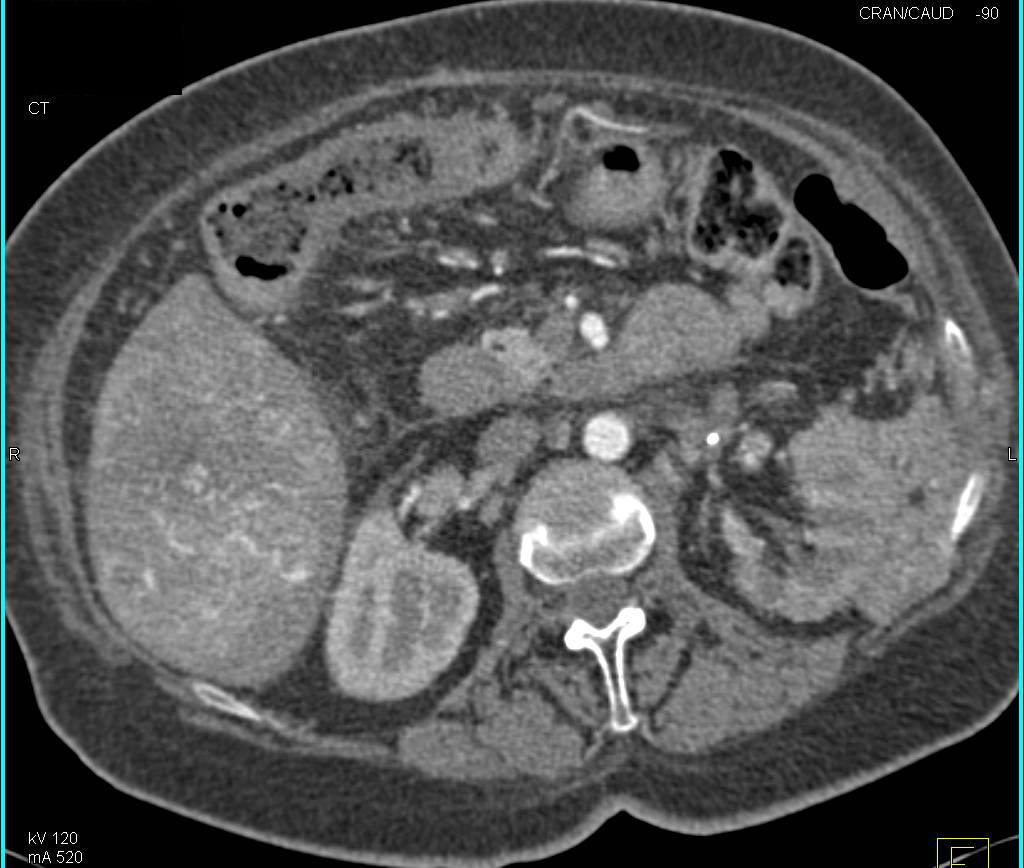 Lymphoma Invades the Adrenal Gland and Perirenal Space - CTisus CT Scan