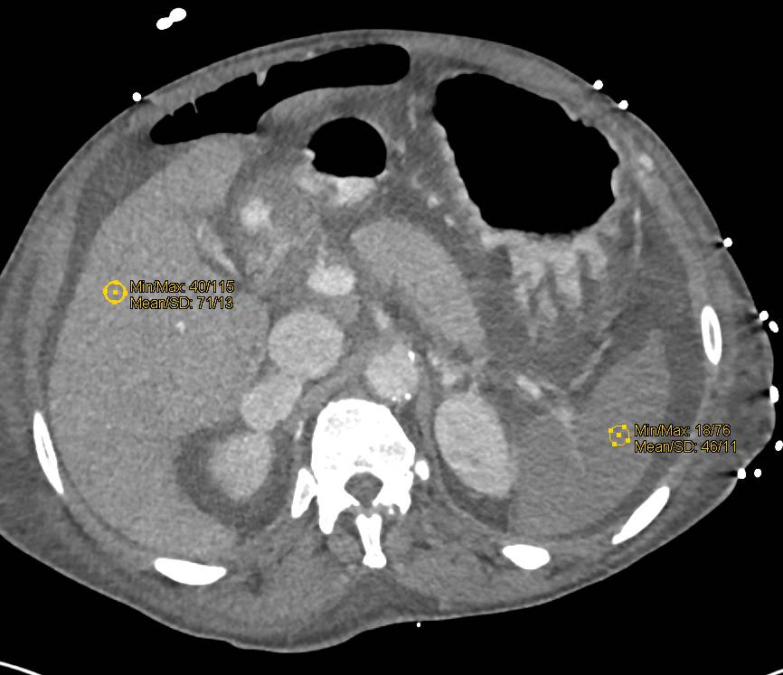 Bright Adrenals in Hypotensive Patient - CTisus CT Scan