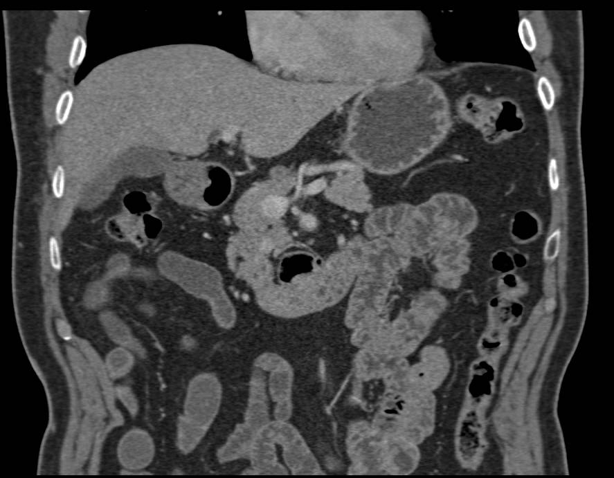 Subtle Metastases to the Head of the Pancreas on Venous Phase Imaging - CTisus CT Scan