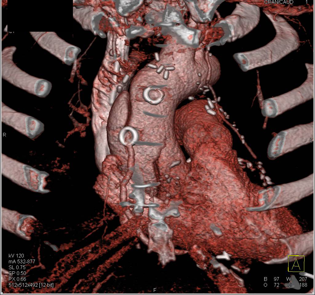 Type A Dissection Nicely Seen with Gated Acquisition - CTisus CT Scan