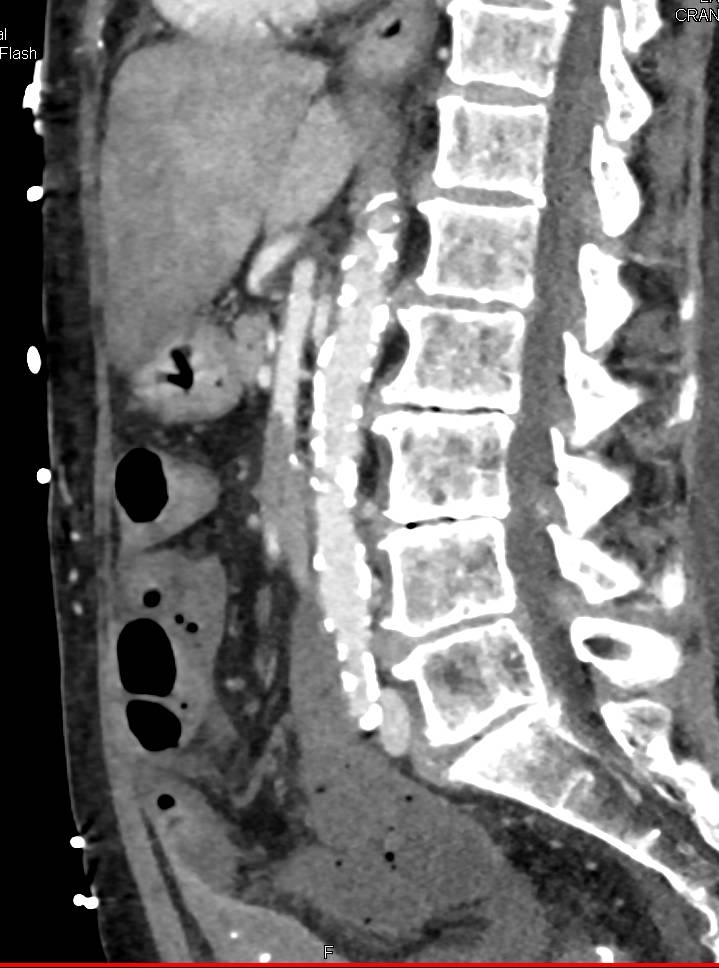 Hypotensive Patient with Superior Mesenteric Artery (SMA) Occlusion - CTisus CT Scan