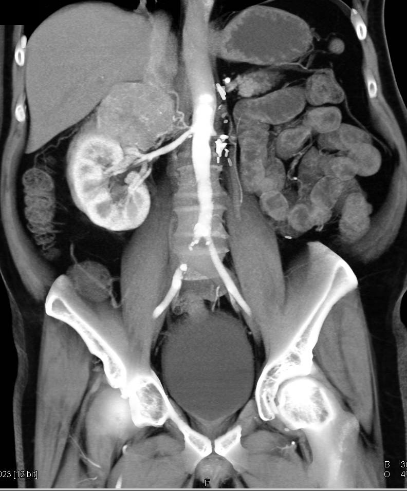 Adrenal Metastases from Recurrent Renal Cell Carcinoma - CTisus CT Scan