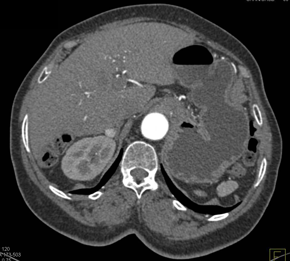 Metastatic Renal Cell Carcinoma to the Right Adrenal Gland - CTisus CT Scan