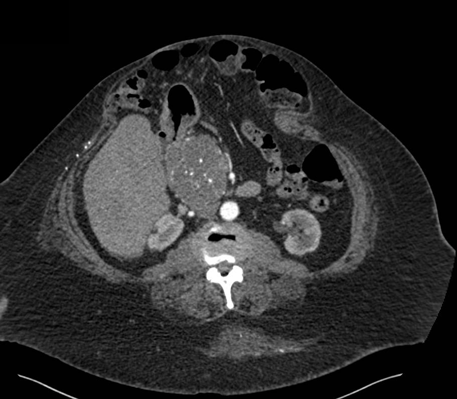 Neuroendocrine Tumor in Head of Pancreas - CTisus CT Scan