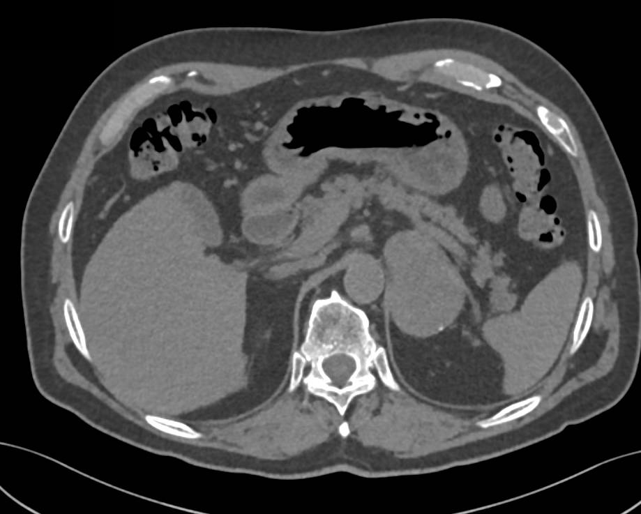 Adrenal Hematoma - CTisus CT Scan