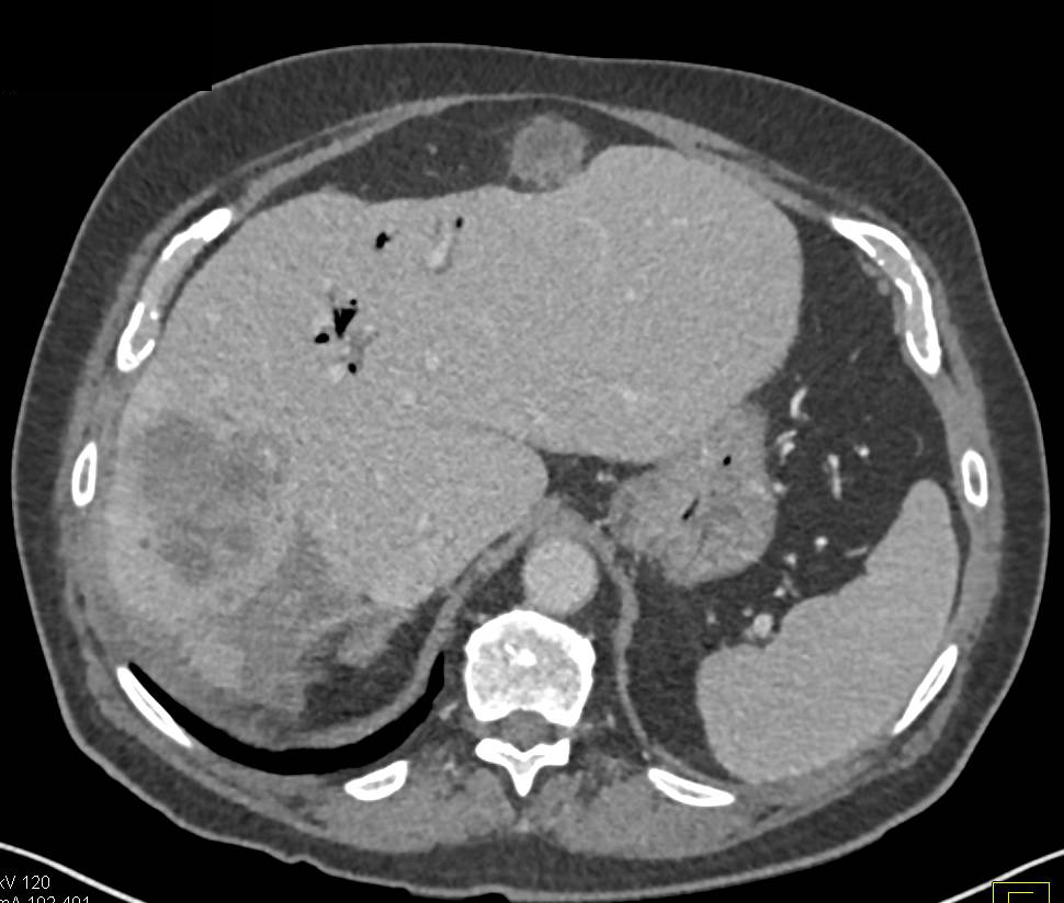 Recurrent Colon Cancer with Metastases to Liver and Node Anterior to Liver - CTisus CT Scan