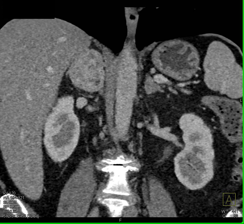 Pheochromocytoma Right Adrenal Gland - CTisus CT Scan