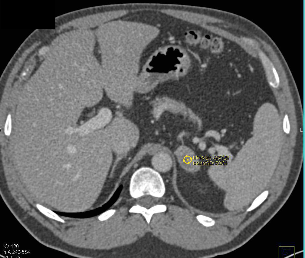 Left Adrenal Adenoma - CTisus CT Scan