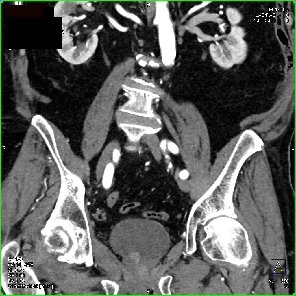 Incidental Bladder Cancer - CTisus CT Scan