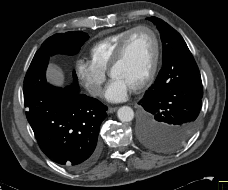 Right Nephrectomy for Renal Cell Carcinoma with Pleural, Lung and Splenic Metastases - CTisus CT Scan